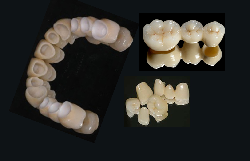 Protesi Fissa, Mobile e Scheletrata Studio Dentista Azzini Trento