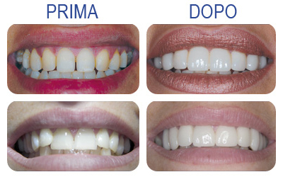 Faccette Dentali Studio Dentistico Azzini Trento